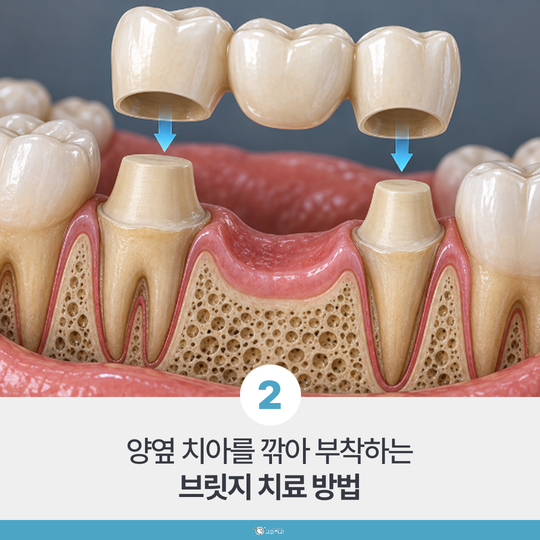 임플란트와 브릿지, 무엇이 더 좋을까요? 이미지 3