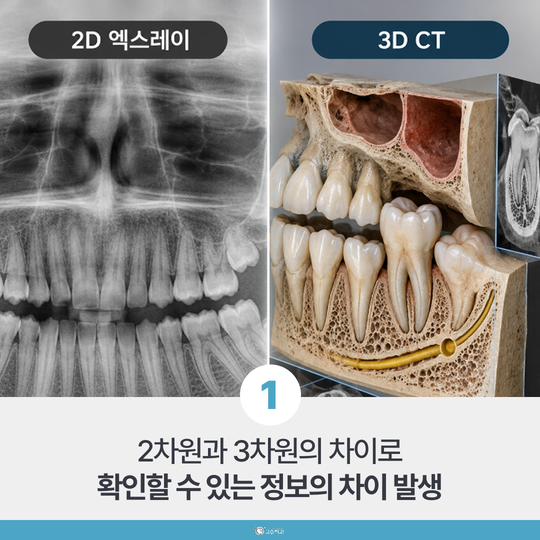 발치 권유 받았을 때 확인할 4가지, 살릴 수 있는 치아 기준이란? 이미지 2