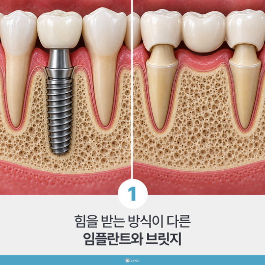 임플란트와 브릿지, 무엇이 더 좋을까요? 이미지 2