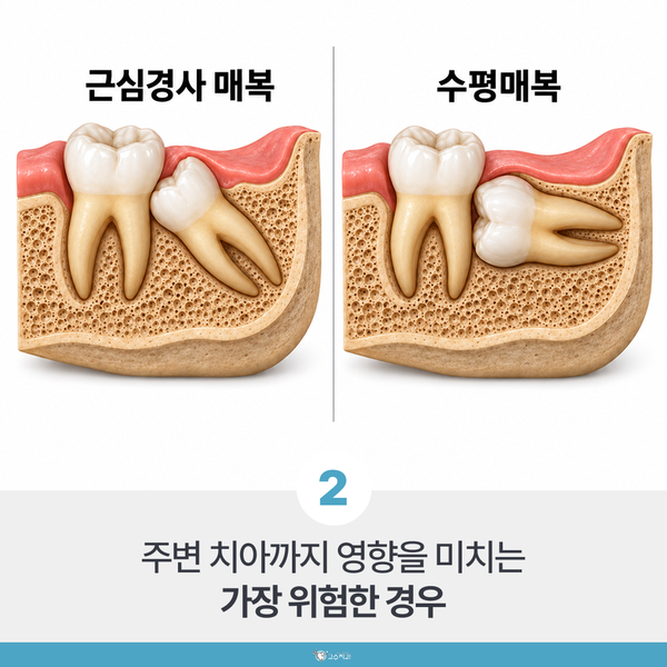 사랑니 발치 기준, 아프지 않아도 빼야 할까 이미지 3