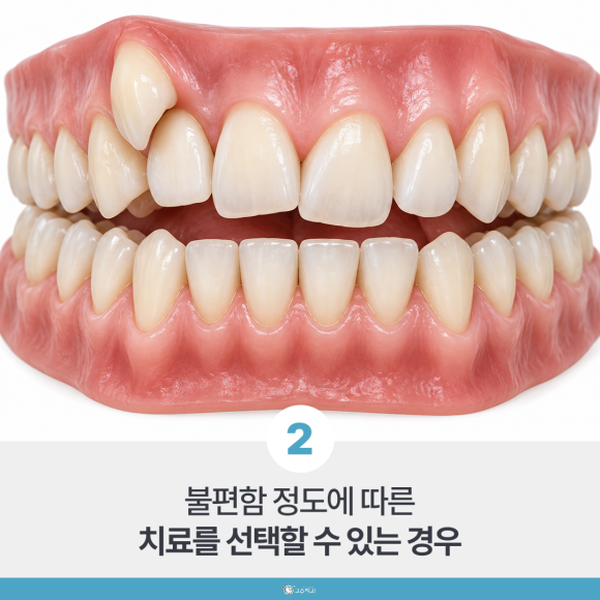 아이 부정교합 교정 시기, 지켜볼 때와 서두를 때 이미지 3