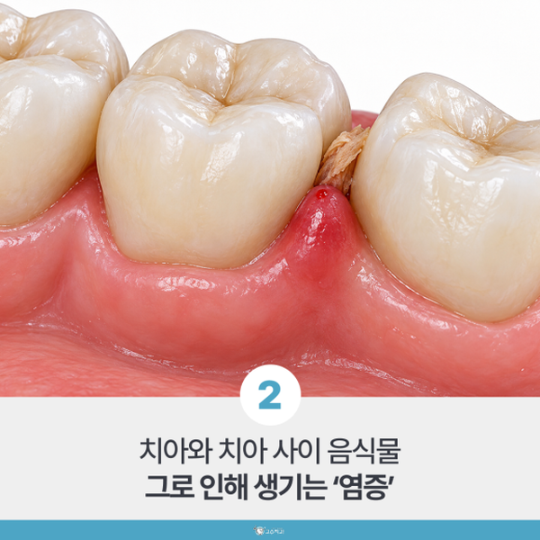 양치할 때 잇몸 피, 나는 자리로 보는 원인 이미지 3