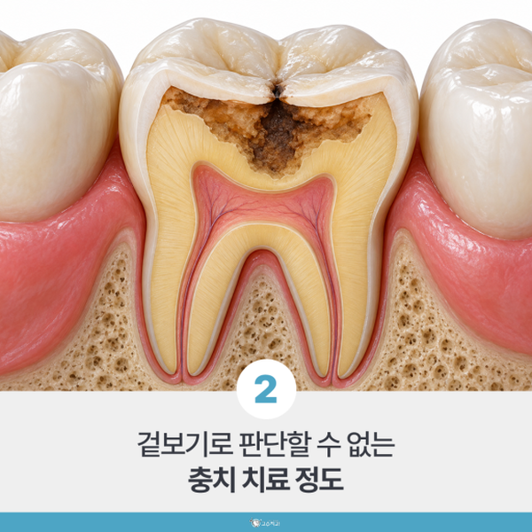충치 치료 비용이 다른 이유, 레진·인레이·크라운 차이점 이미지 3