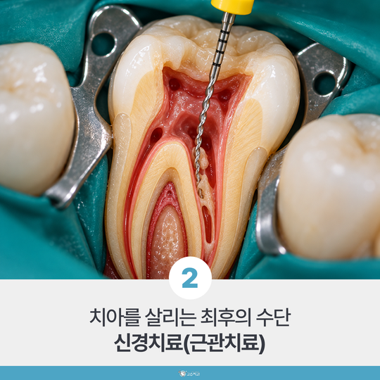 발치 권유 받았을 때 확인할 4가지, 살릴 수 있는 치아 기준이란? 이미지 3