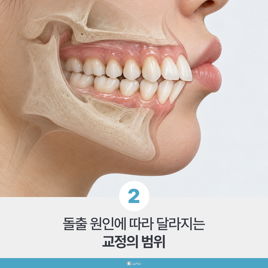 성인 돌출입 교정, 원인별로 어디까지 들어갈까 이미지 3