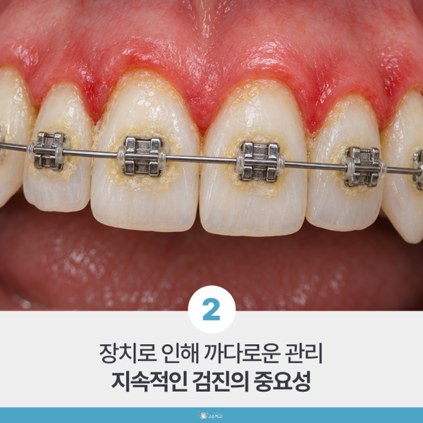 교정 중 치아 흔들림, 지켜봐도 되는 경우와 아닌 경우 이미지 3