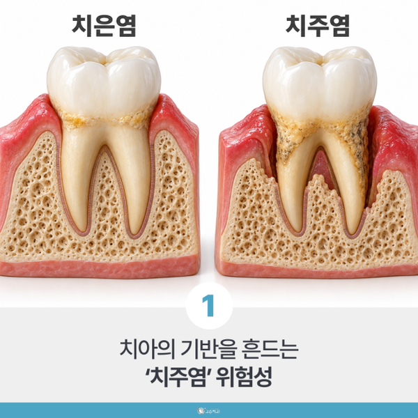 양치할 때 잇몸 피, 나는 자리로 보는 원인 이미지 2
