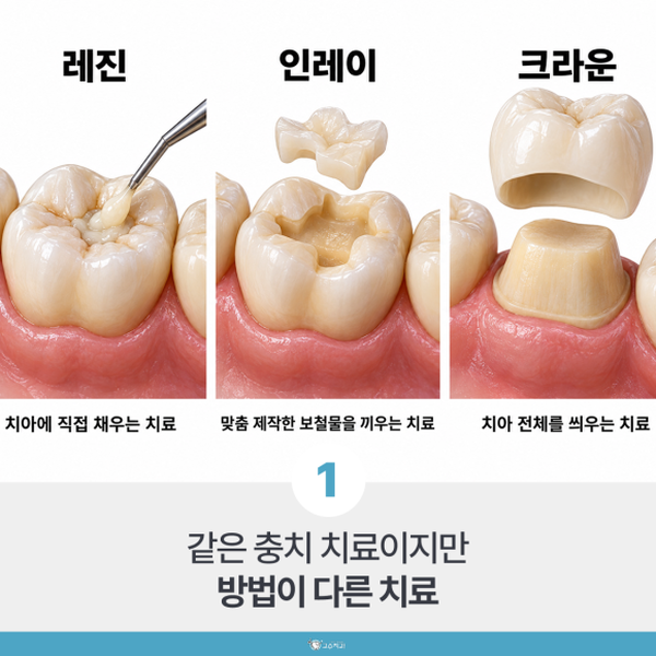 충치 치료 비용이 다른 이유, 레진·인레이·크라운 차이점 이미지 2